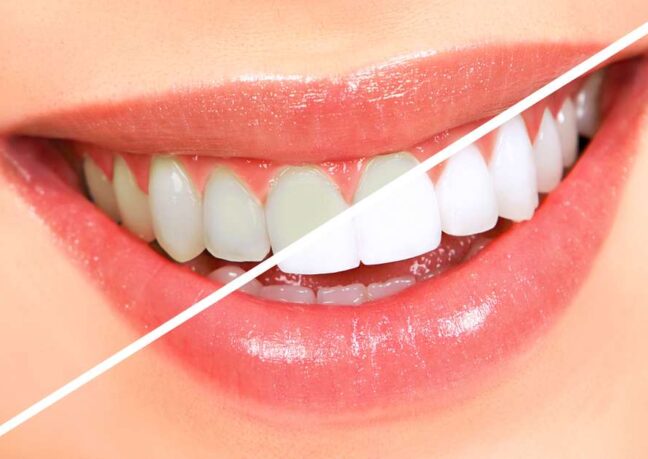 Cosmetic dentistry