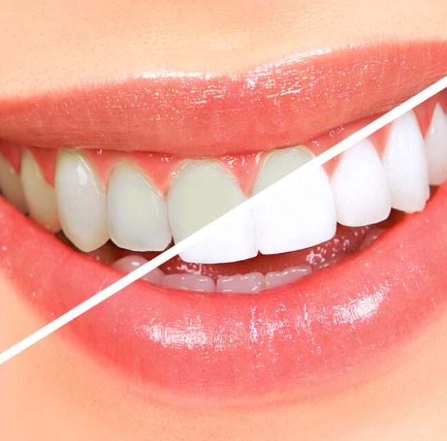 Cosmetic dentistry