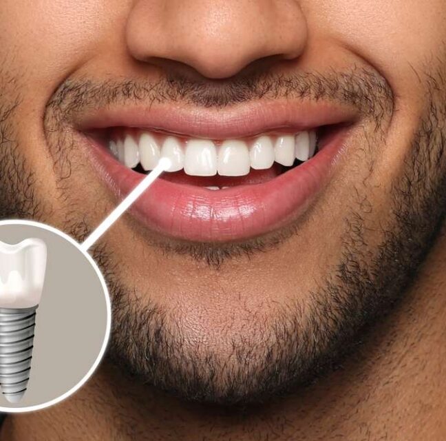Blog - Sutton Dental & Implant Clinic