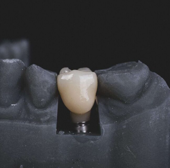 Blog - Sutton Dental & Implant Clinic