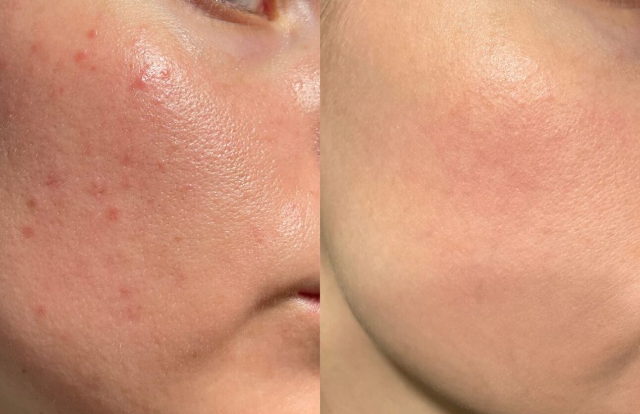 Sutton Dental Cryotherapy Skin Tightening