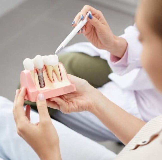 Dental Implants vs Bridges: Which Option Preserves Teeth Better?