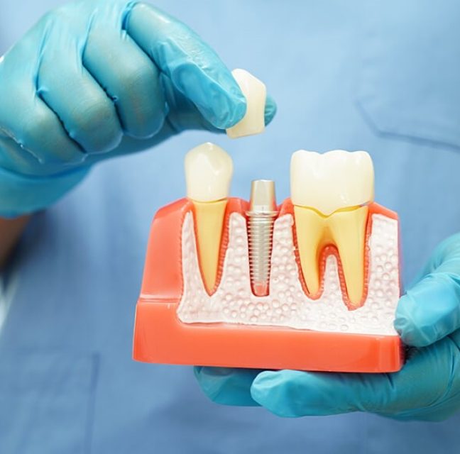 Do Dental Implants Feel Like Real Teeth? Patient Experience Explained