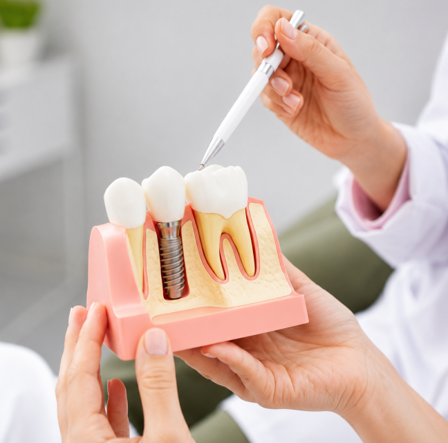 What to Eat After Dental Implant Surgery